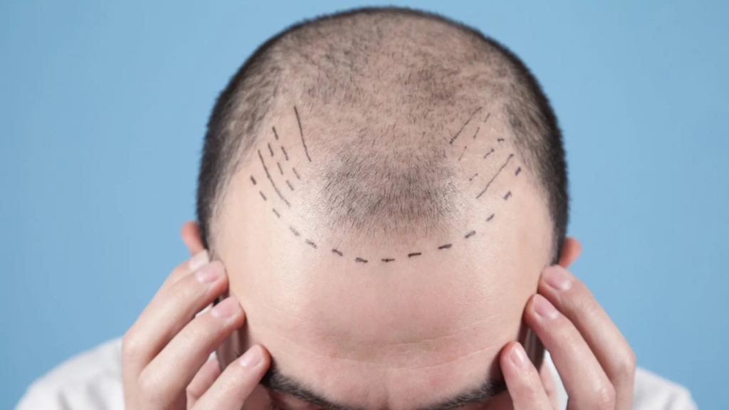 Hair Transplant Costs in 2025 Why Colombia Delivers World-Class Results at Half the Price
