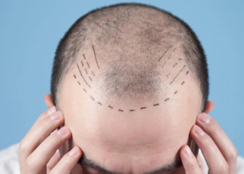 Hair Transplant Costs in 2025 Why Colombia Delivers World-Class Results at Half the Price