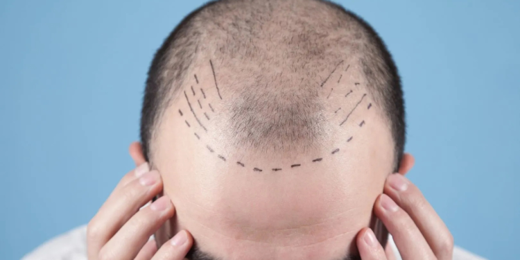 Hair Transplant Costs in 2025 Why Colombia Delivers World-Class Results at Half the Price