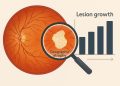 Close-up of retinal scan highlighting lesion growth in geographic atrophy clinical research