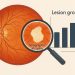 Close-up of retinal scan highlighting lesion growth in geographic atrophy clinical research